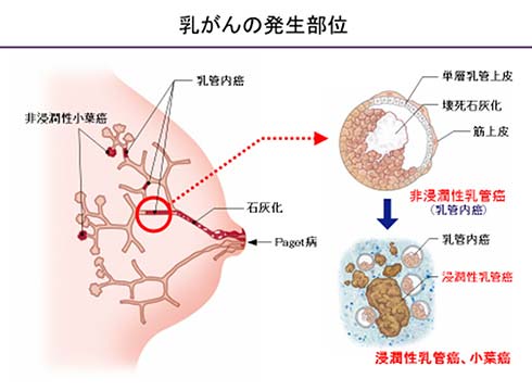 乳がんの発生部位